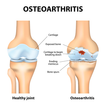 illustration of osteoarthritis in knee joint