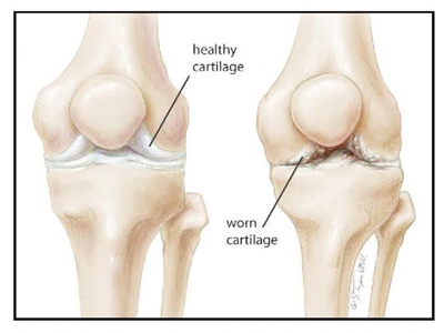 healthy and worn cartilage in knee arthritis