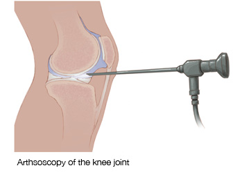 arthroscopy of the knee joint
