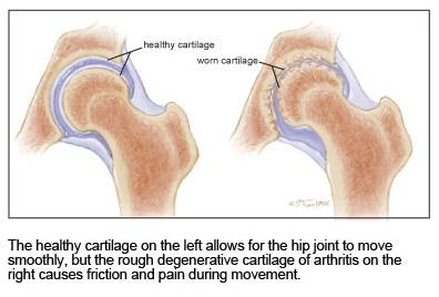 illustration of hip joint with and without arthritis