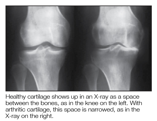 x-ray comparison of healthy and arthritic knee cartilage