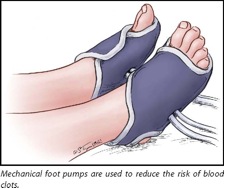 illustration of mechanical foot pumps