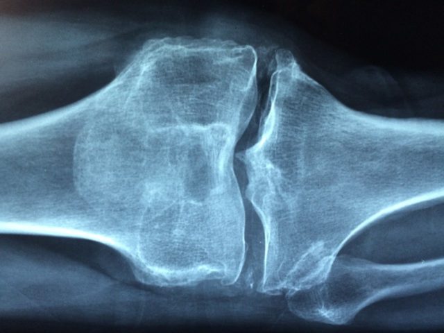 knee arthritis xray