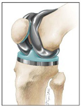 total knee replacement illustration