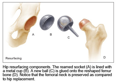 hip replacement parts components