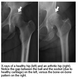 x-ray of healthy hip and arthritic hip