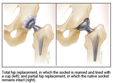 illustration of total hip replacement