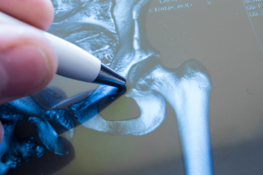 xray illustration of damaged hip